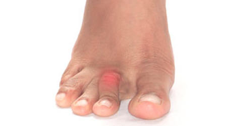 Hammertoes