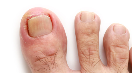 Ingrown Toenails